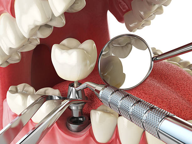 Best Emergency Dentist for Lost Fillings or Crowns in Peach Springs, AZ